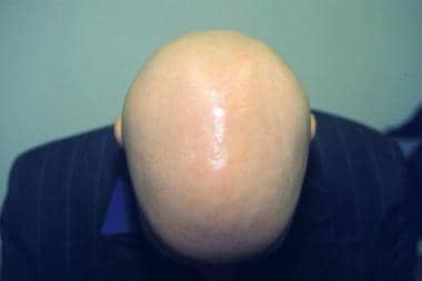 Alopecia totalis. 