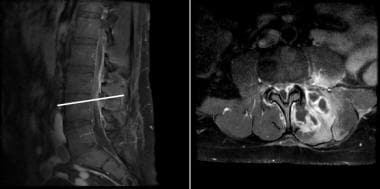 An MRI of the lumbar spine (T1-weighted, post-cont