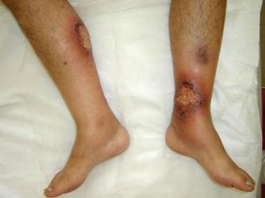 Pyoderma gangrenosum in a patient with hidradeniti
