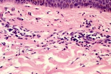 Histopathologic features of leukocytoclastic vascu