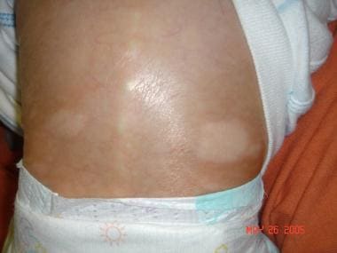 Sclerodermatous skin changes in Hutchinson-Gilford