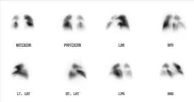 University of California, San Francisco: Lung Shaped Blood Clot