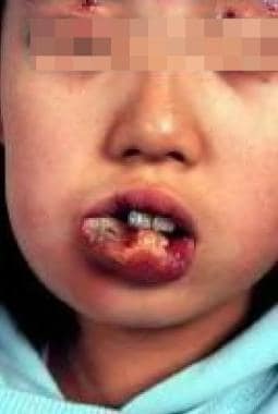 Major aphthous ulcer. 