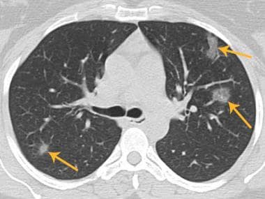 Axial chest CT of a COVID-19 patient demonstrating