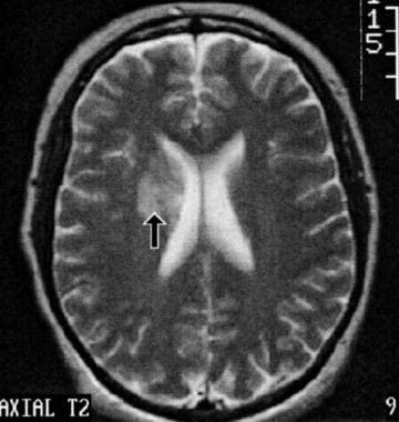 This axial, T2-weighted brain magnetic resonance i