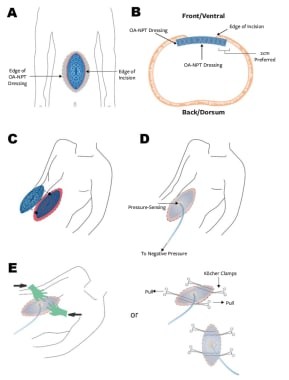 Temporary Abdominal Closure