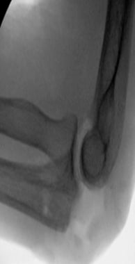 Excision of olecranon after nonunion of fracture i