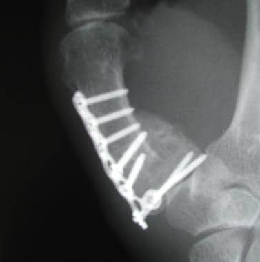 Radiograph of a healed Rolando fracture following 