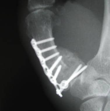 rolando vs bennett fracture