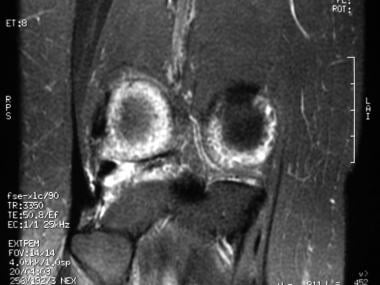 Coronal T2-weighted MRI of patient with synovial c
