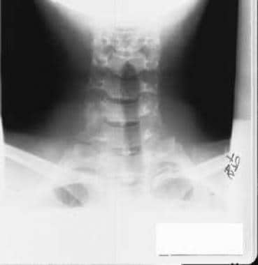 Radiograph of cervical spine of 15-year-old girl. 