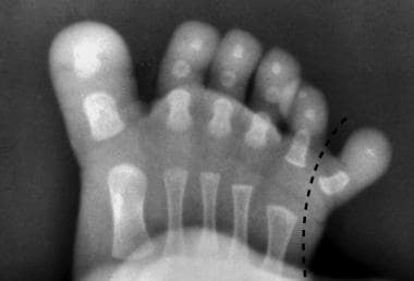 Postaxial polydactyly in a 1-year-old child. In th