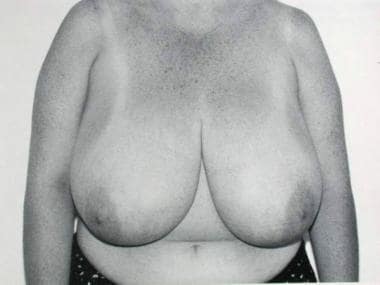 Preoperative status of breasts with lateral nipple