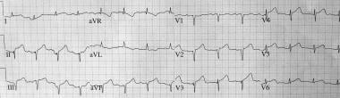 Takotsubo (stress) cardiomyopathy (broken heart sy