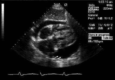 Subcostal view of an echocardiogram that shows a m