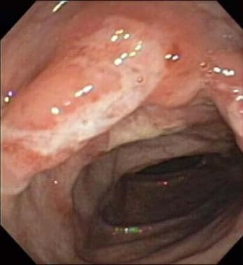 Crohn disease. The colonoscopy image reveals a lar