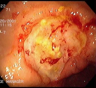 Peptic ulcer disease. Gastric ulcer with a punched