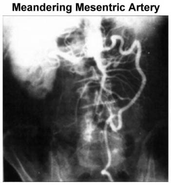 Arteriogram illustrates meandering mesenteric arte