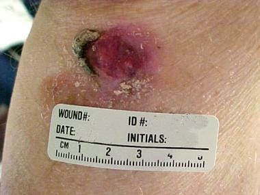Basal cell cancer manifesting as a chronic leg ulc