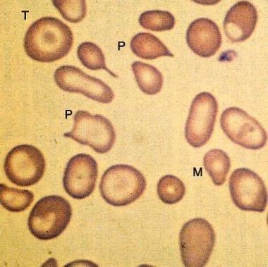 Peripheral smear from a patient with beta-zero tha