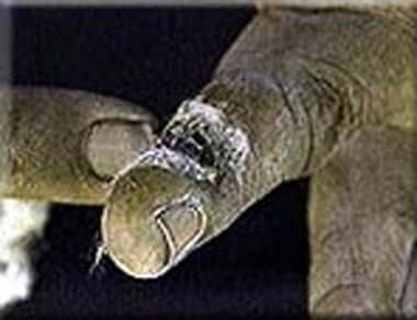 Cutaneous anthrax. Image courtesy of Anthrax Vacci