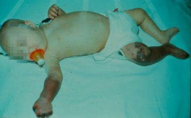 Childhood polyarteritis nodosa. Gangrene of the fo