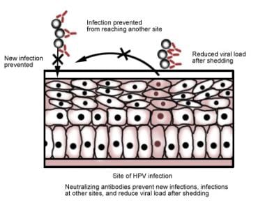 csatorna papilloma medscape)