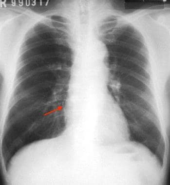Delayed posteroanterior chest image shows aspirati