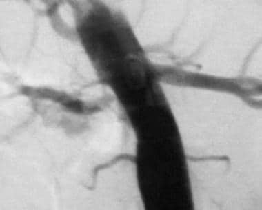 Aortogram of 8-year-old child with neurofibromatos