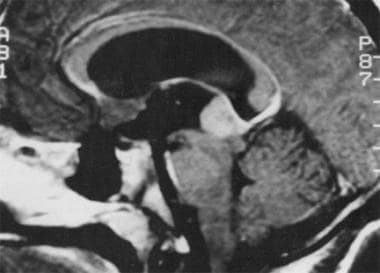 MRI of a 21-year-old man with a germinoma in the p