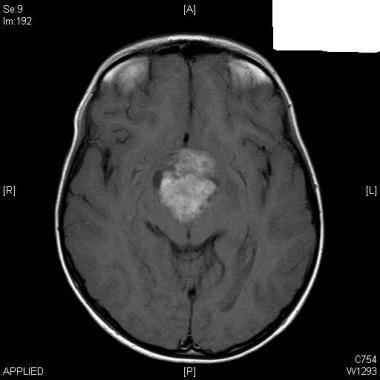 MRI of the brain - axial view- heterogeneous mass 