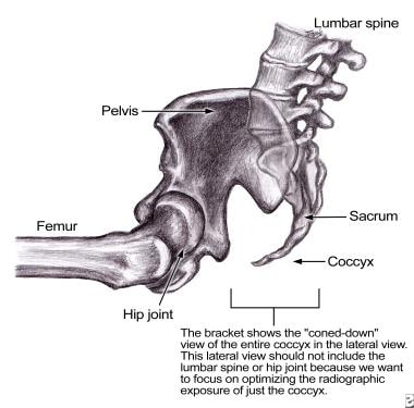 Lateral view of the pelvis and coccyx. The bracket