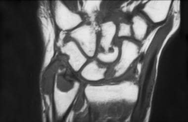 Rheumatoid arthritis. Coronal, T1-weighted magneti