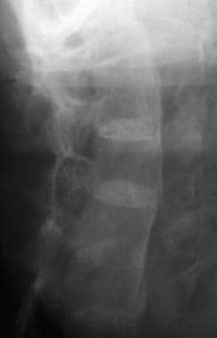 This radiograph of the lumbar spine of a patient w