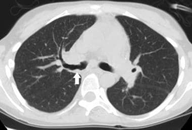 Lung Transplantation Treatment & Management: Medical Therapy, Surgical ...