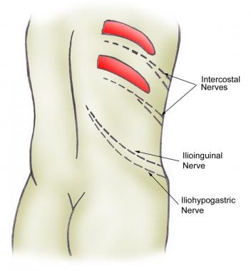 Nephrolithiasis: acute renal colic. Distribution o