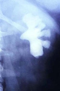 Staghorn renal calculus is noted on plain radiogra