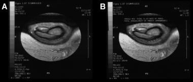 MRI of the penis in the axial plane (T1-weighted i