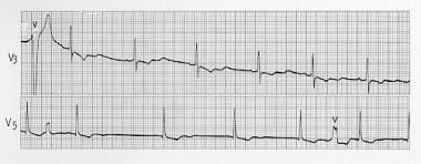 Prominent U waves after T waves in hypokalemia. 