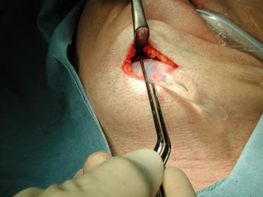 Placing implant through a submental incision. 