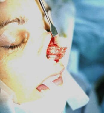 An open excision of a nasal boss. 