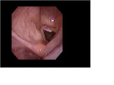 Fiberoptic endolaryngeal view of an early glottic 