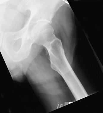 A view of the contralateral hip for comparison. 