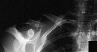 Additional view of fracture displacement and commi