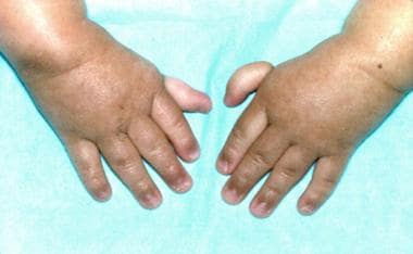 Thumbs attached by threads on a 3-year-old patient