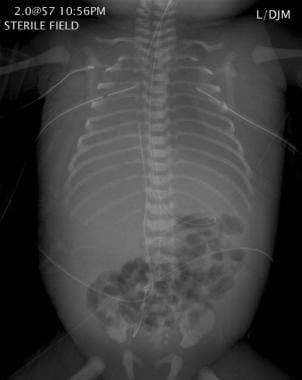 Chest and abdomen radiograph revealing the presenc