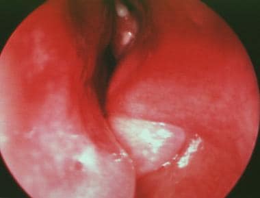 Rigid endoscopic view of the left nasal cavity. Th