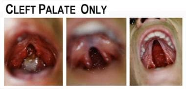 Examples of cleft palate. 