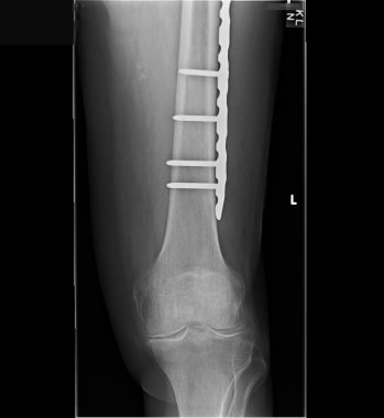Periprosthetic fracture.