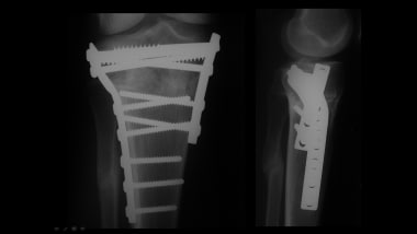 Growth plate (physeal) fractures. Healed proximal 